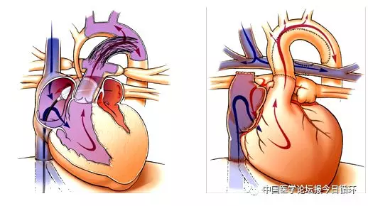 浅谈胎儿心脏病介入治疗