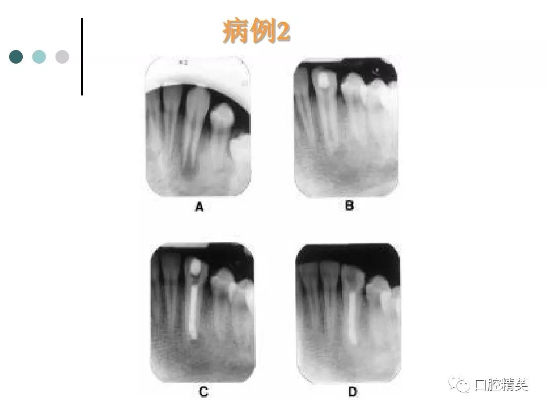 根尖诱导成型术《附病例》