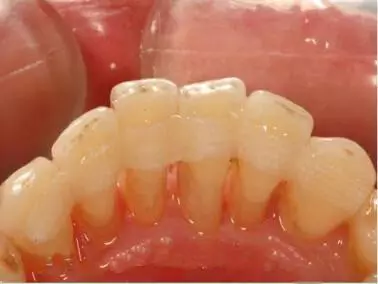 临床上通常使用牙周夹板来固定松动牙齿,分散牙合力,提高患者的咀嚼