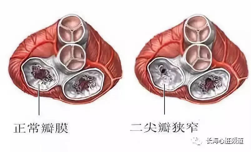 3二尖瓣狭窄