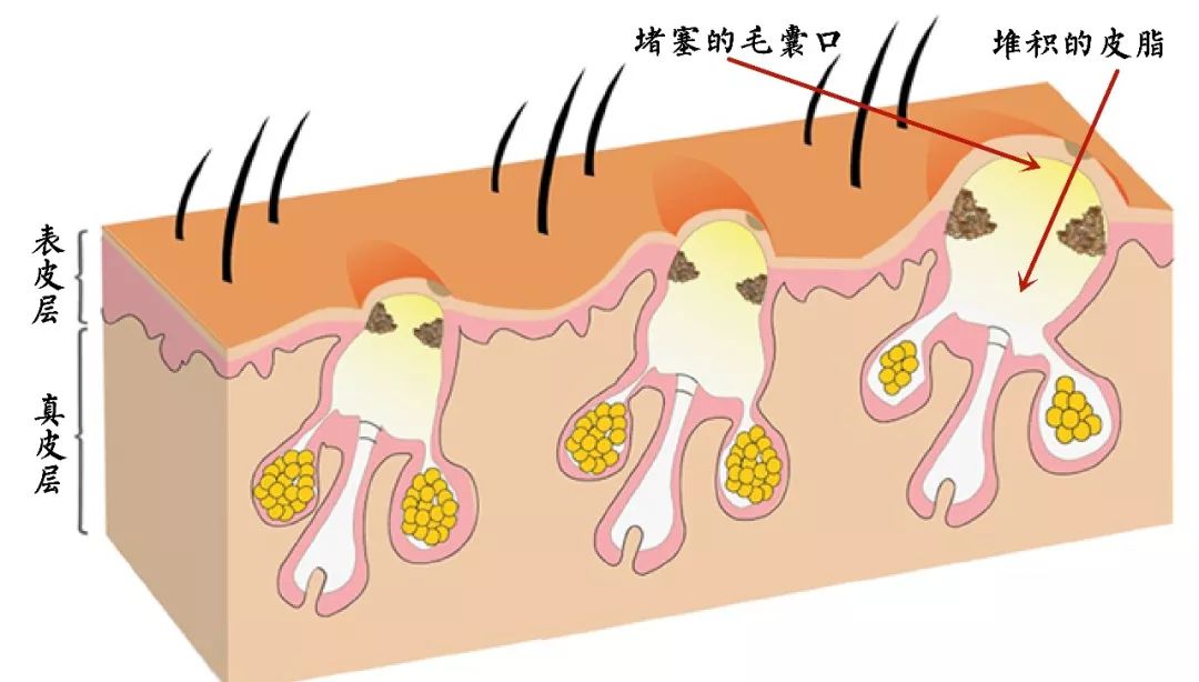 「外干内油」的本质是:皮脂腺活跃地有恃无恐,毛囊口角化程度愈趋