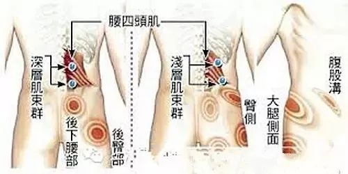 有一种伤不起的痛,叫肌筋膜炎