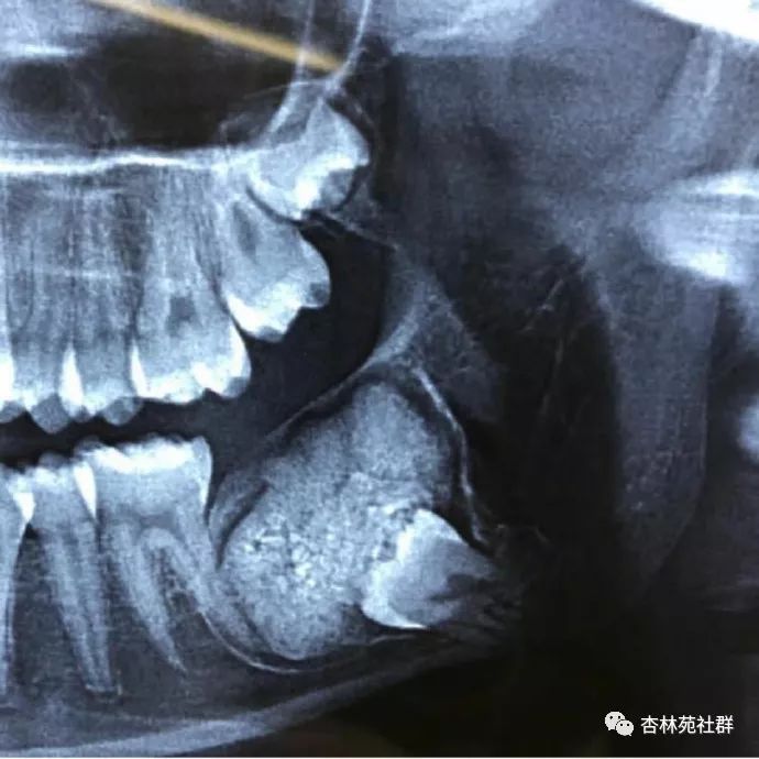 阻生牙伴发骨质增生