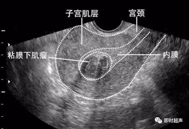 小型粘膜下子宫肌瘤声像图8-3-10 阔韧带肌瘤声像图8-3-9 带蒂浆膜下