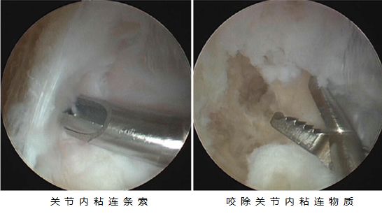 关节粘连怎么办