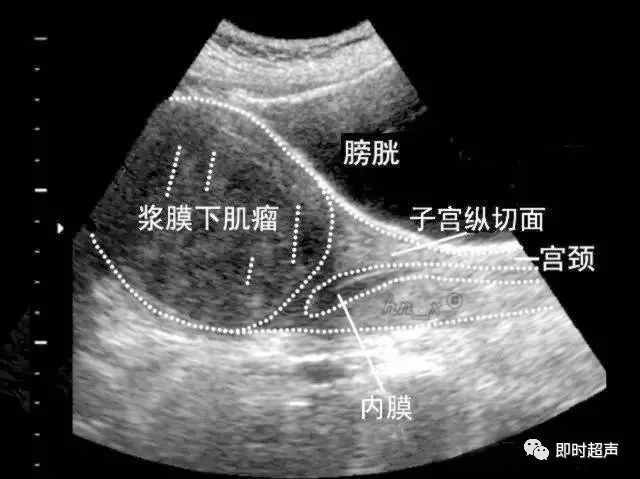 3) 粘膜下肌瘤:经阴道超声扫查表现为子宫内膜变形或缺损,内膜下肌层