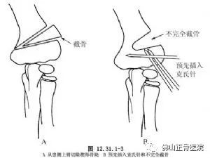 钢板内固定,肱骨下段楔形嵌入截骨矫形术治愈30°肘内翻!