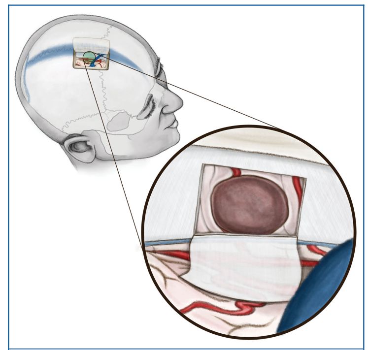 作用下垂提供手术操作空间,在内镜下切开大脑镰切除对侧半球内侧面的