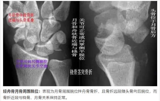 腕关节大全解剖骨折脱位值得收藏