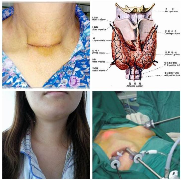 普外科成功实施首例经乳晕完全腔镜下甲状腺肿瘤切除术