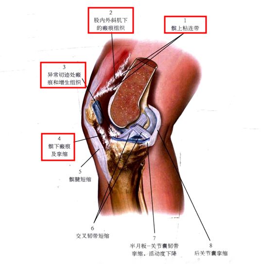 下面我们以 膝关节术后粘连为例来了解