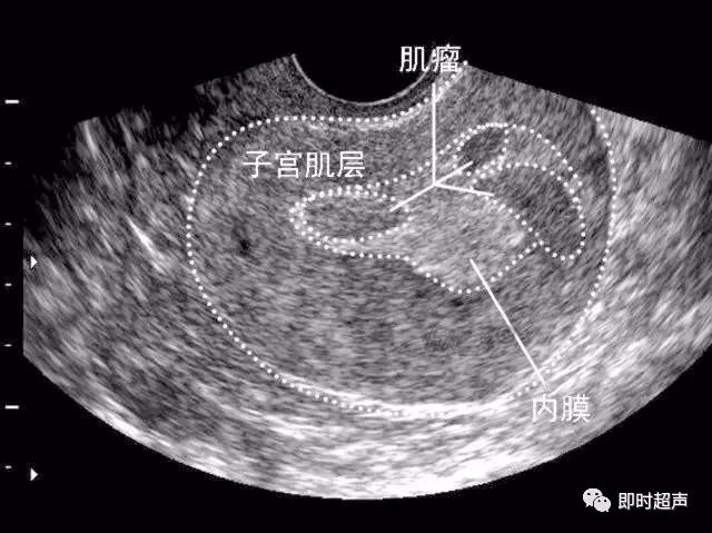 子宫肌瘤超声分类诊断