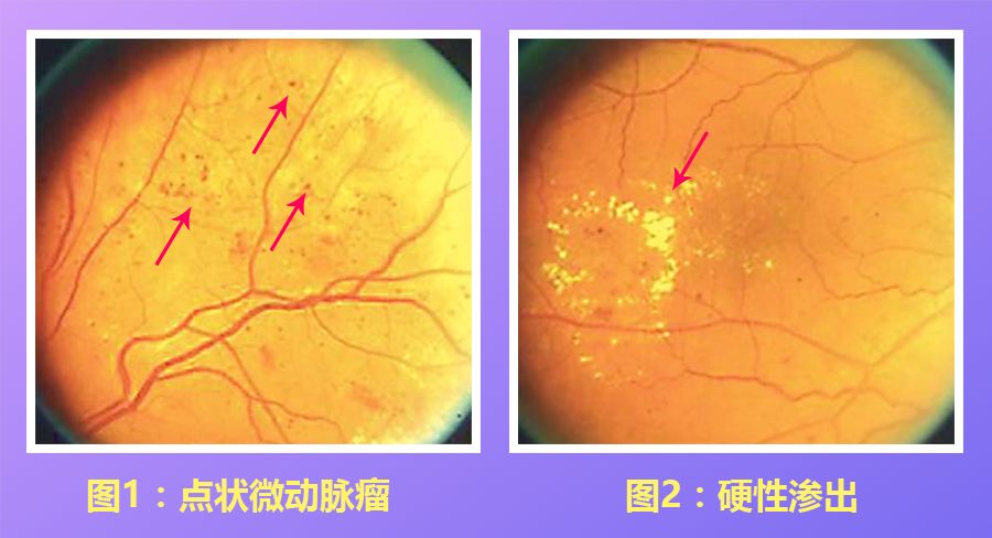 硬性渗出物主要由脂质组成,并且表现为黄色白色病灶,通常具有明显的