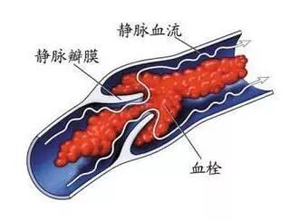 出现这6个症状,说明你体内有血栓啦!