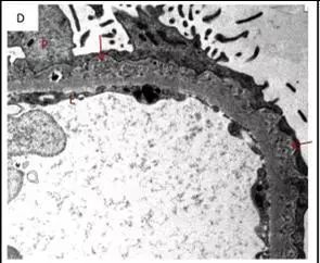 新认识足细胞折叠性肾小球病
