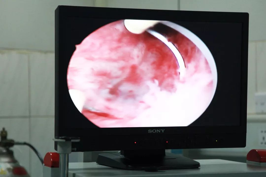 延安市中医医院妇产科成功实施宫腔镜电切术