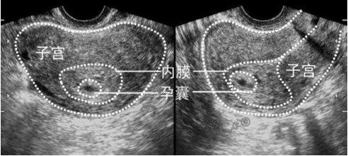 孕囊形状可以看出胎儿是男是女,一般说来,如果孕囊的形状像茄子,或者