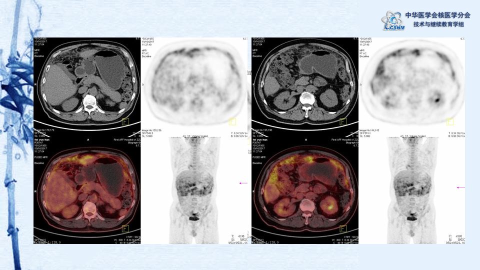 【病例】07期:程兵 | 恶性弥漫型腹膜间皮瘤pet/ct显像一例