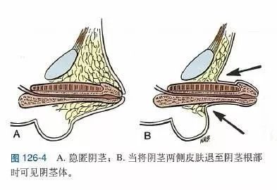 这些肥胖男孩阴茎外观小的原因