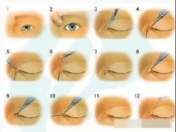 干货| 无痕开眼角技巧(2)——手术过程