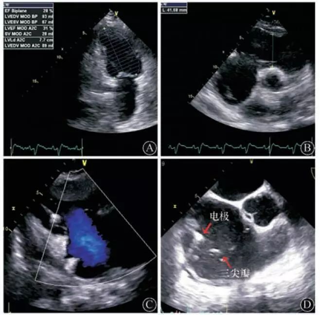 图3d),未见左心耳及左右心房血栓.