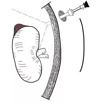 临床中最常用的办法就是再在腹部打一个trocar,或者改变镜头孔和操作