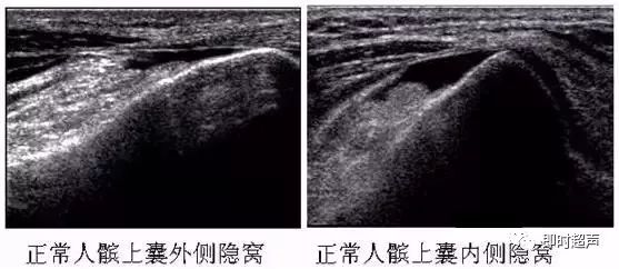 膝关节解剖和9种膝关节结构正常声像图