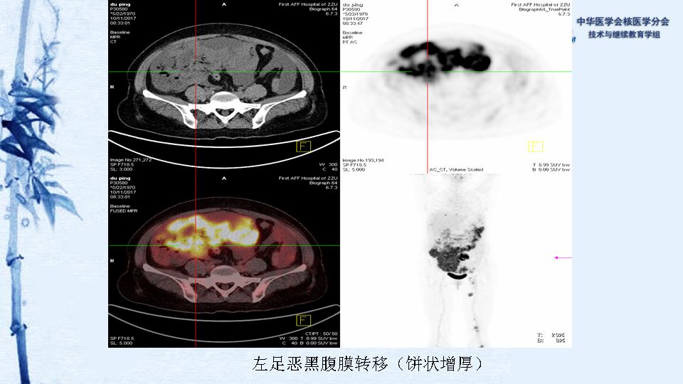 【病例】07期:程兵 | 恶性弥漫型腹膜间皮瘤pet/ct显像一例