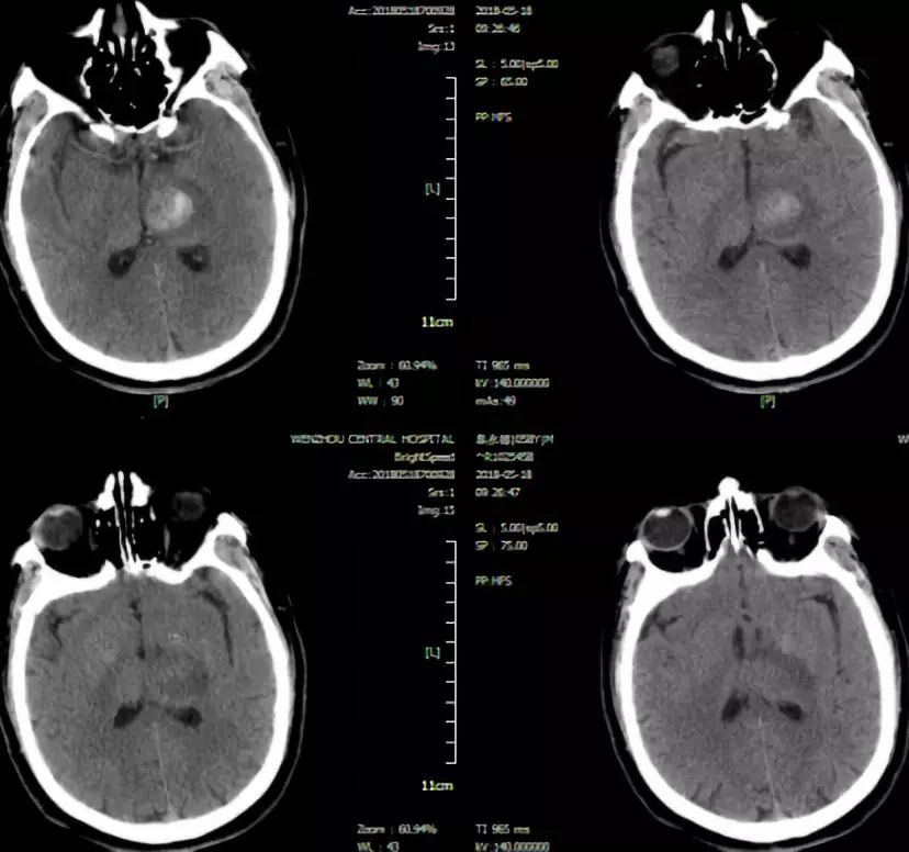 头颅ct:左侧丘脑异常信号,提示出血,首先考虑血肿.