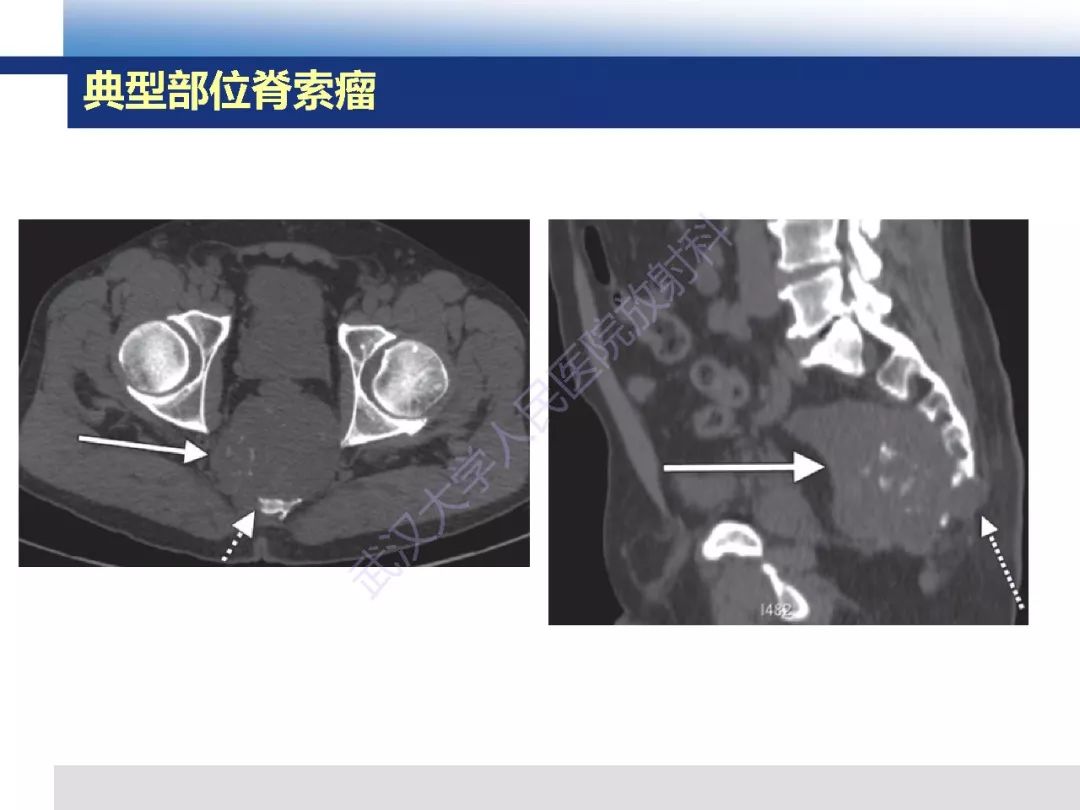 颅底软骨样脊索瘤影像诊断