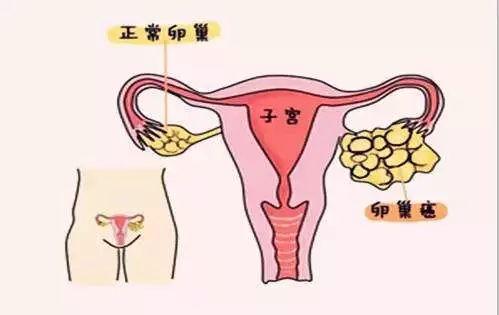 「招募」这样的晚期卵巢癌患者有望获免费治疗,快来报名吧!