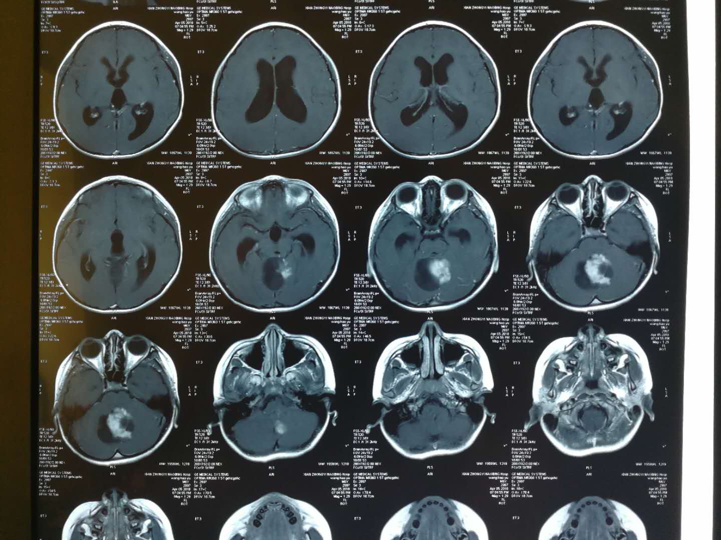 贺晓生教授谈儿童脑瘤手术小儿四脑室毛细细胞型胶质瘤的手术治疗