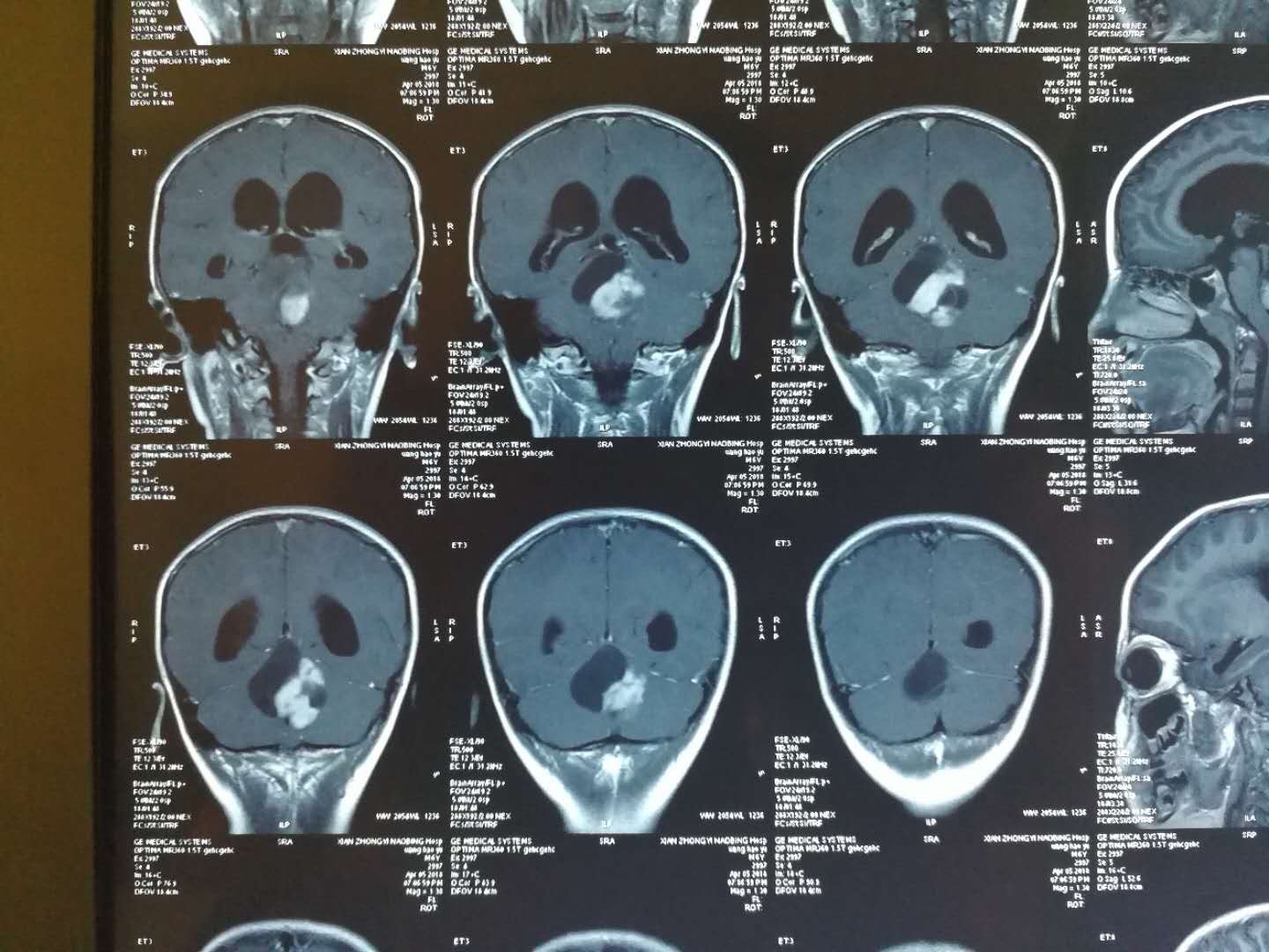 贺晓生教授谈儿童脑瘤手术小儿四脑室毛细细胞型胶质瘤的手术治疗