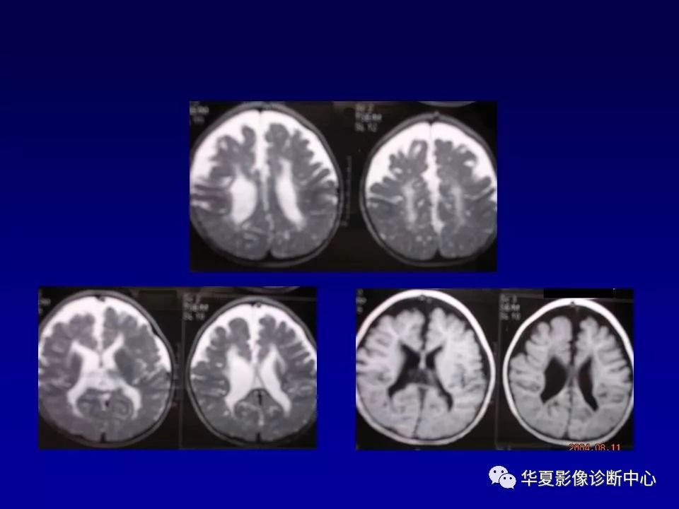 新生儿脑室周围白质软化的影像学特点