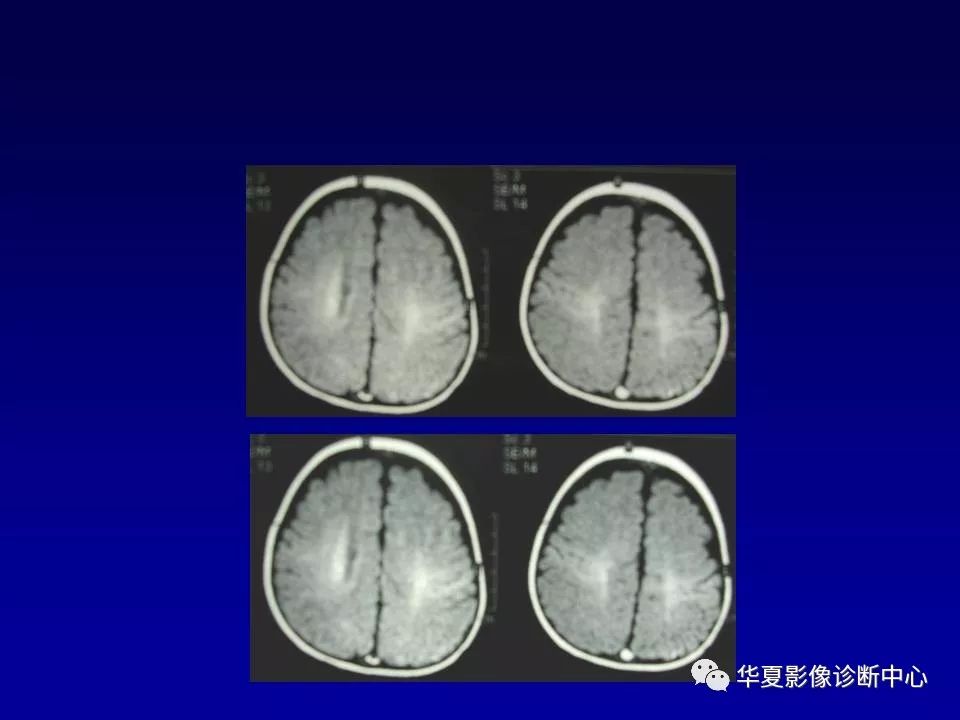 新生儿脑室周围白质软化的影像学特点