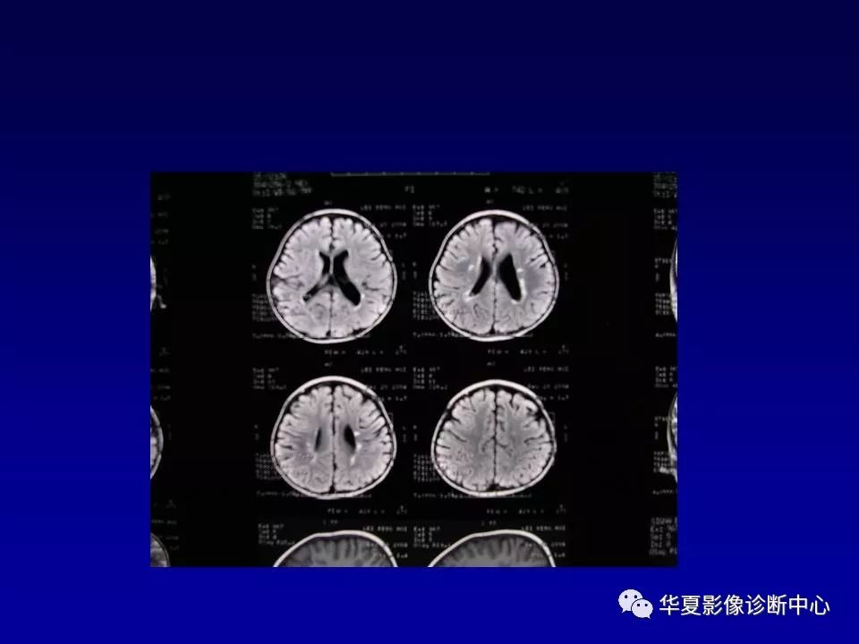 新生儿脑室周围白质软化的影像学特点