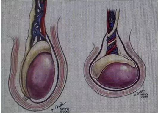13岁男孩"蛋疼"强忍,痛失右睾!注意它释放的5个信号