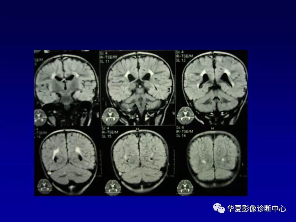 新生儿脑室周围白质软化的影像学特点