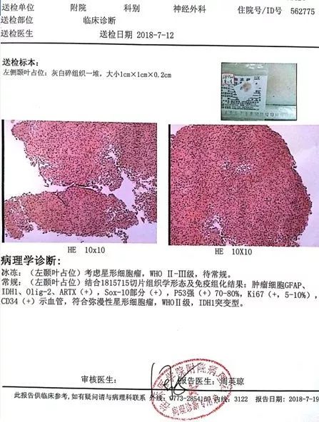 夏学巍:复发星形细胞瘤行二次手术切除病例 | 神经肿瘤周刊第14期