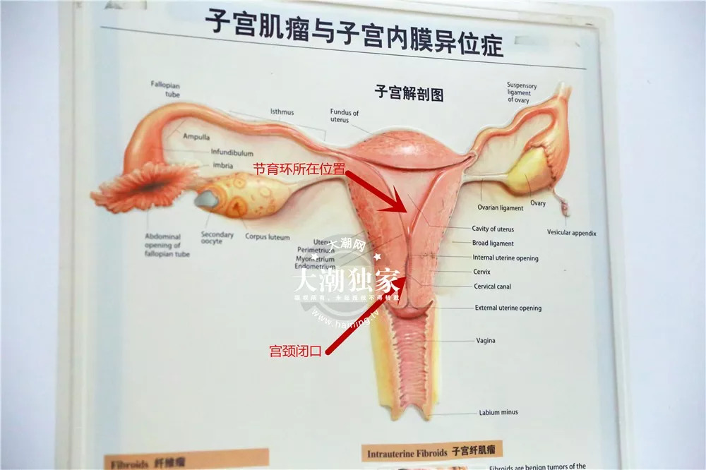 这个节育环已经在孙阿姨体内放了整整25年.