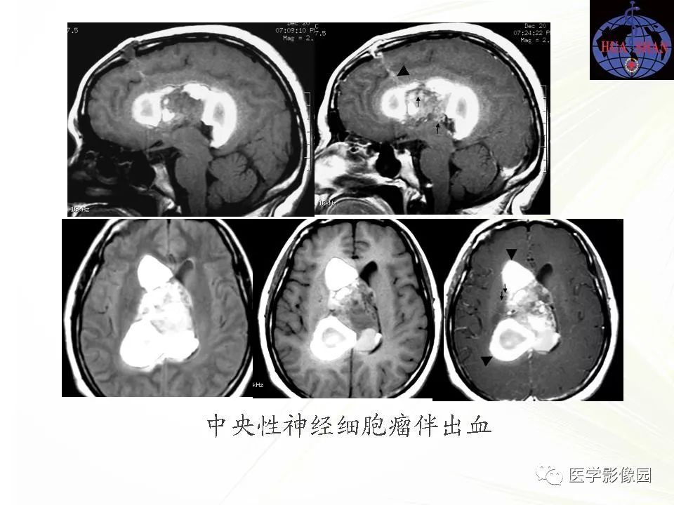 脑室肿瘤的诊断与鉴别诊断影像天地