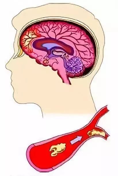 二,缺血性脑卒中高血压等原因导致血管破裂血管开始出现问题正常的