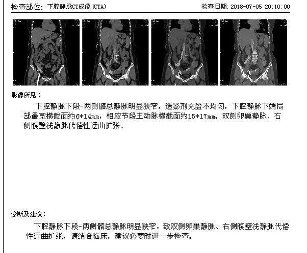 对吻技术在下腔静脉慢性阻塞疾病中的微创治疗及思考附3例病例分析