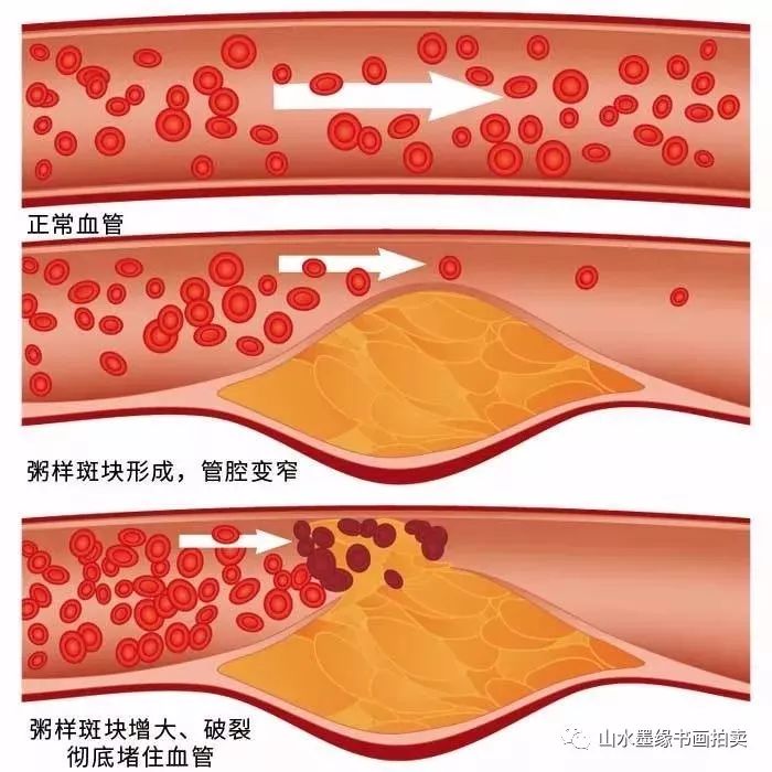 血流顺畅;不健康的血管,内壁会产生一种堵塞血管的物质,医学上叫斑块