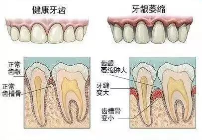 我的牙缝太大，可以补吗？