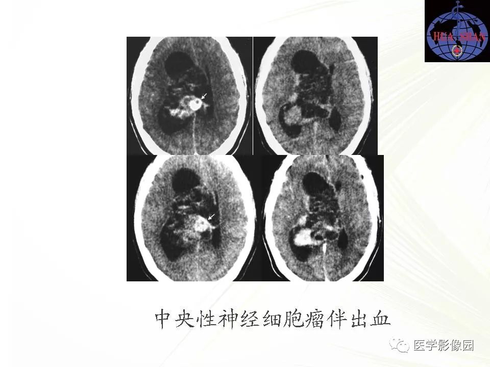 脑室肿瘤的诊断与鉴别诊断影像天地