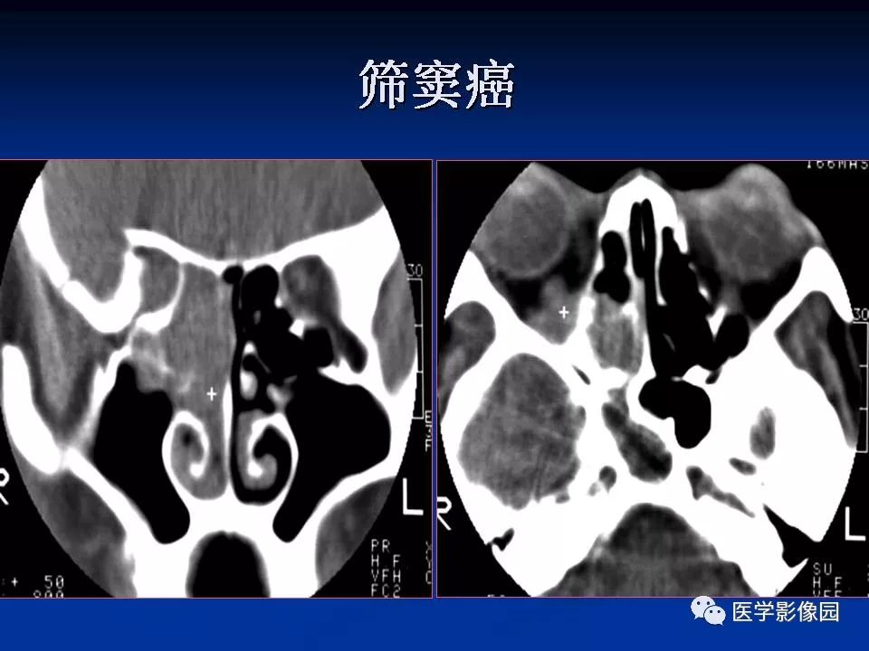 鼻腔鼻窦良恶性肿瘤的ctmr诊断二影像天地