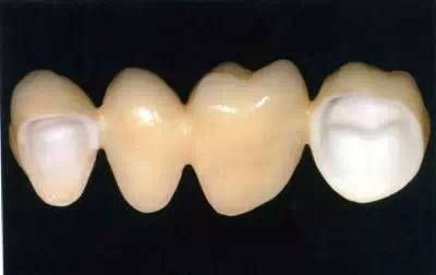为什么牙医叫你做二氧化锆全瓷牙？ 看完你就知道了