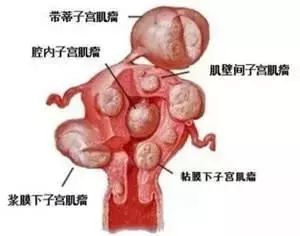临产孕妈妈子宫肌瘤大如足球,一个肚里两个"娃"!