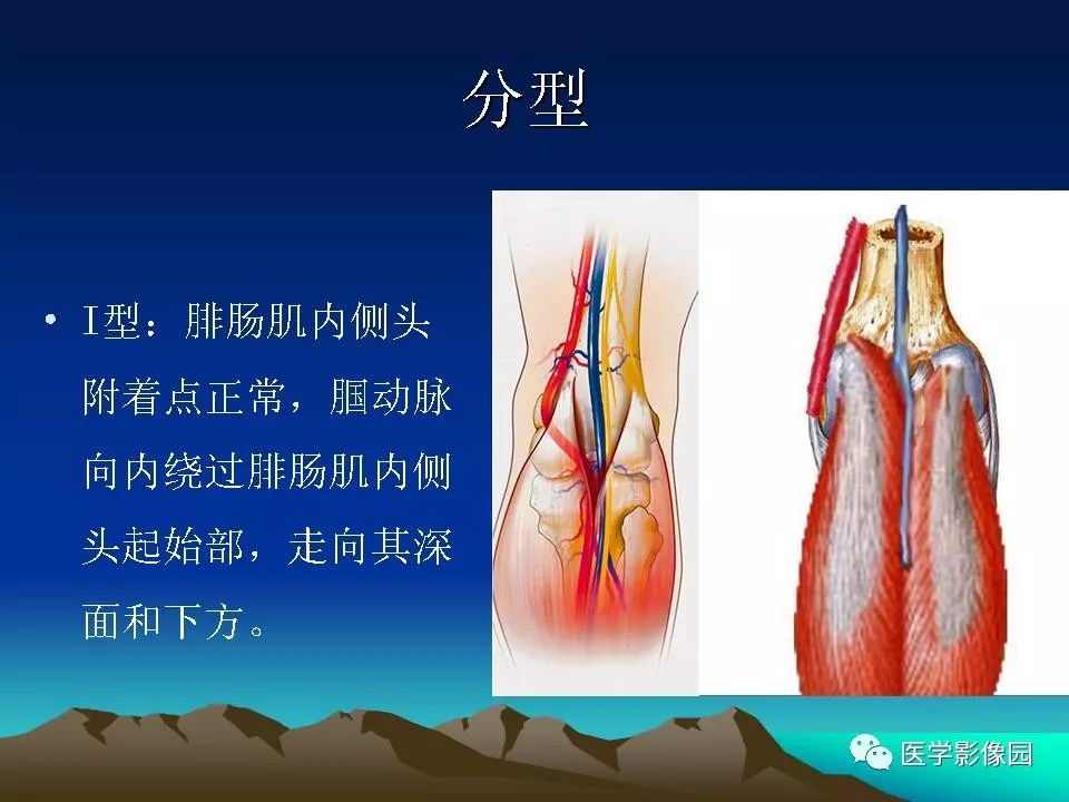 腘动脉陷迫综合征影像学诊断 | 影像天地